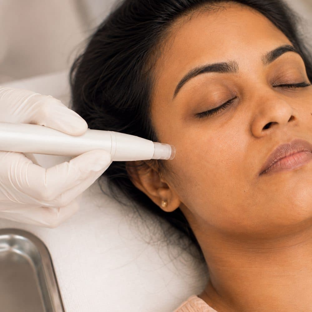 A microneedling pen being drawn across a patient's cheek.