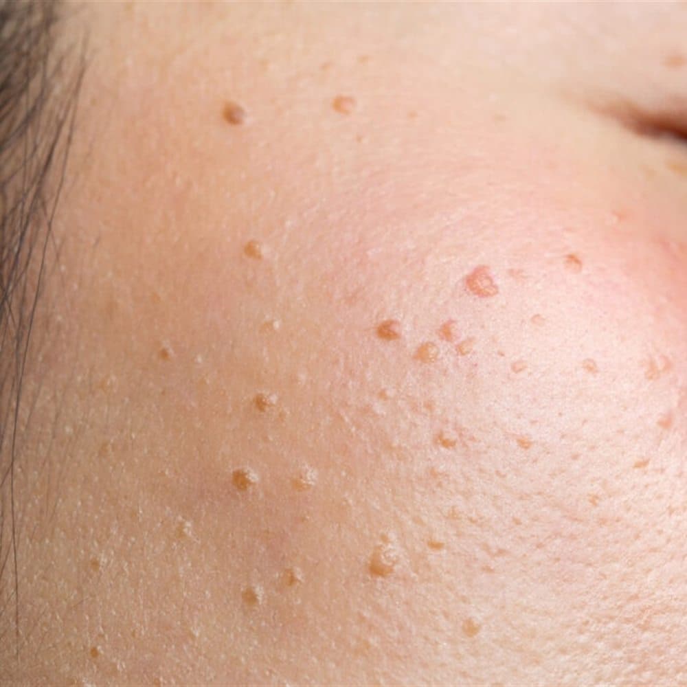 A close-up of small raised warts clustered on the skin beside a closed eye.